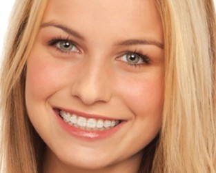 Girl smiling with braces