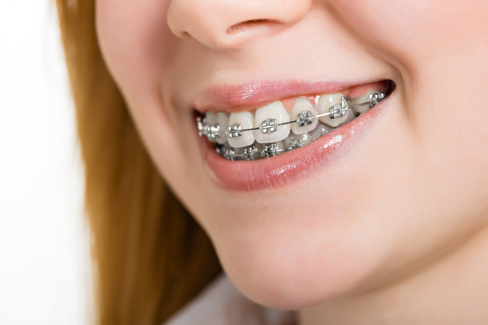 Traditional Braces  Wright and Feusier Orthodontics - Get