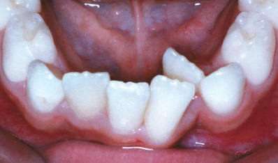 2 Rows of Teeth