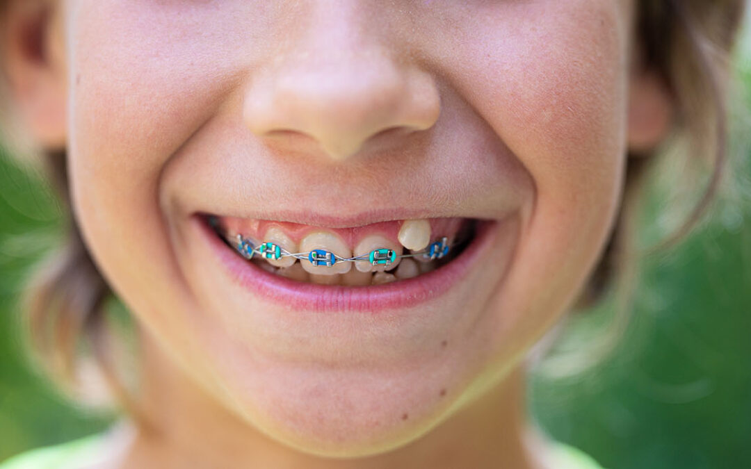 Knowing the Signs Your Child Needs Braces