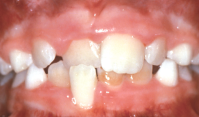 Crossbite of front teeth