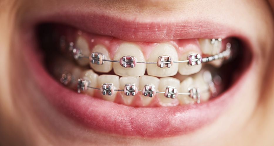 Maintain Oral Hygiene with Braces