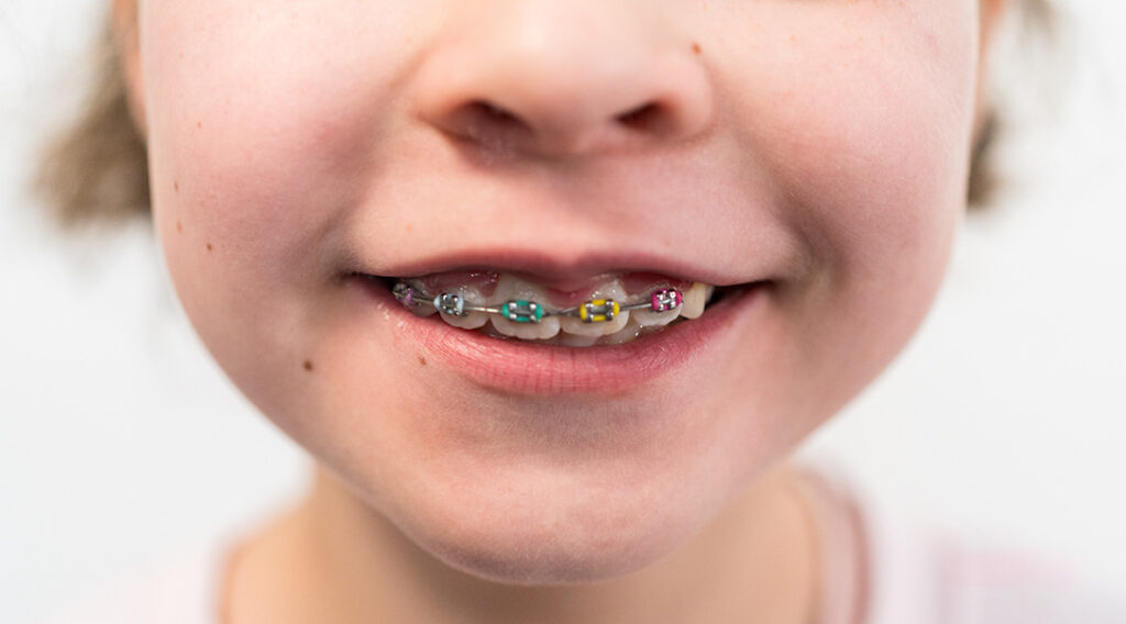 Benefits of Early Orthodontic Evaluation