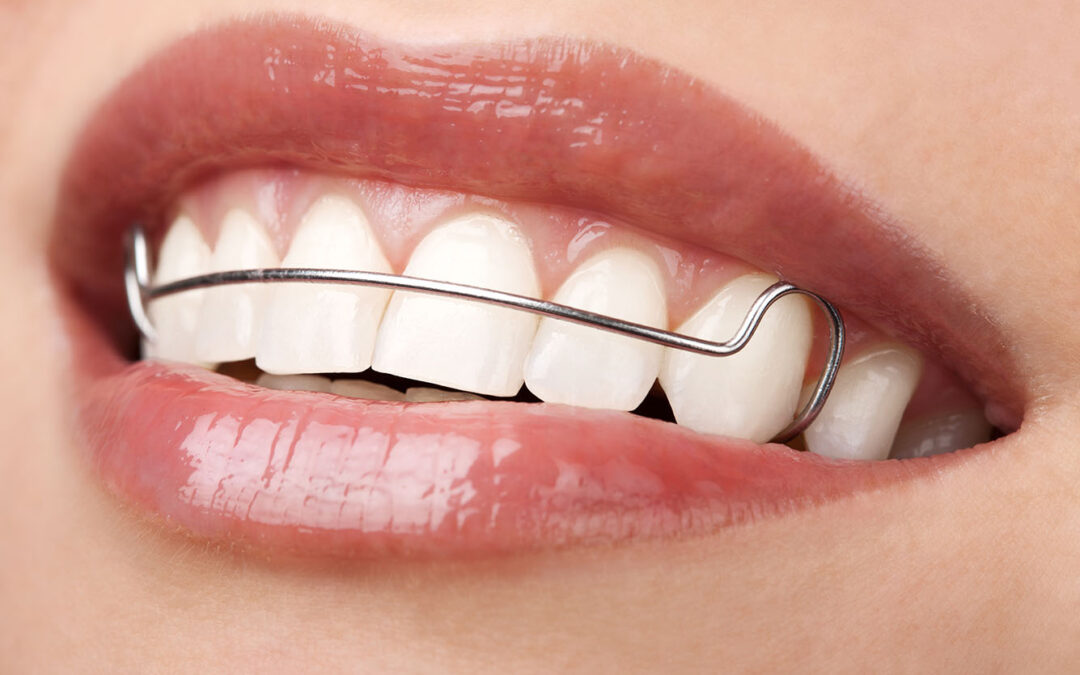 Unlocking the Secret to Lasting Smiles: The Vital Role of Retainers After Invisalign